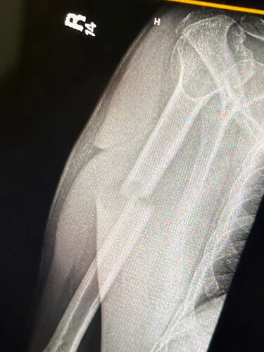 humerus break