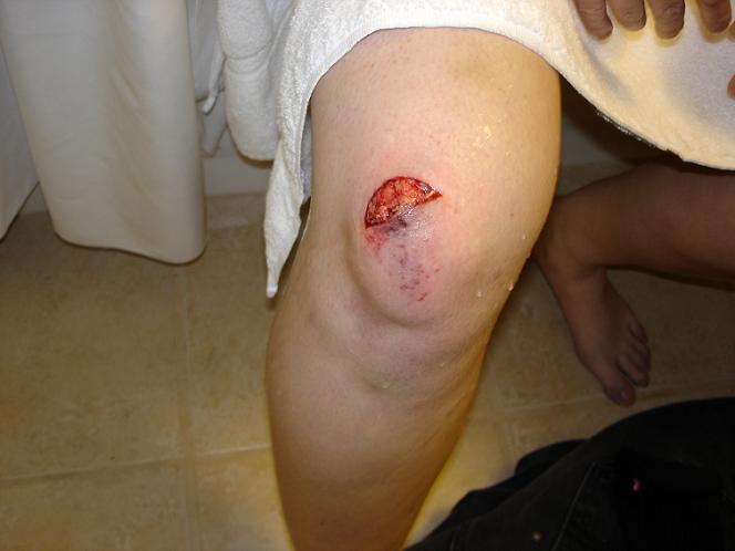 Veroniques leg.JPG